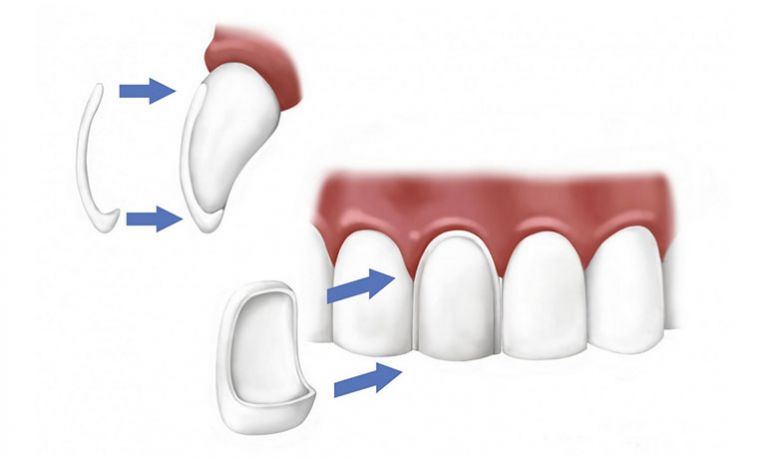 Faccette dentali roma come si applicano