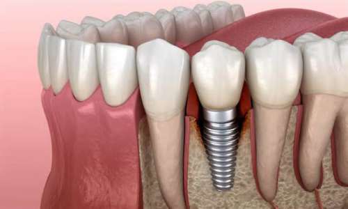 Tipologie di Implantologia dentale Monza